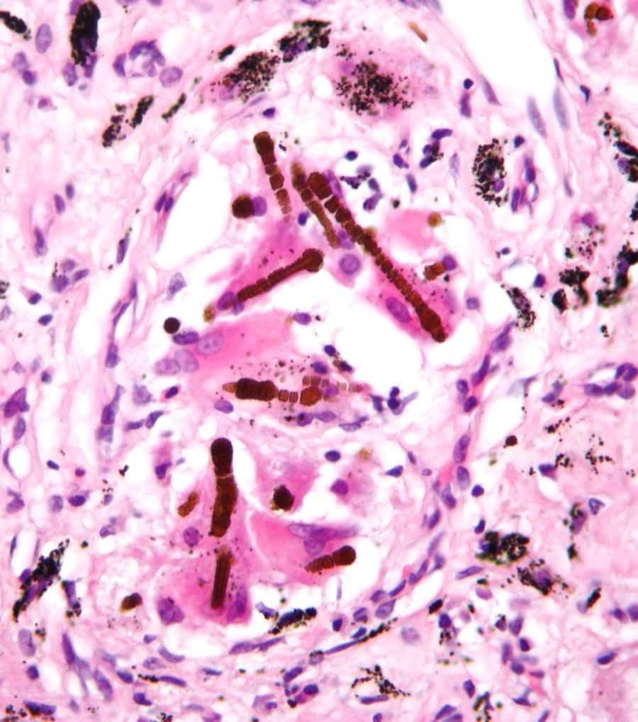 Ferruginous body in lung tissue: golden-brown asbestos fiber coated in iron-protein, dumbbell shape