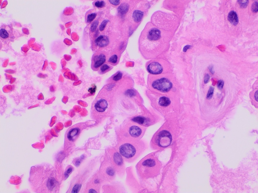 Papillary thyroid carcinoma histology