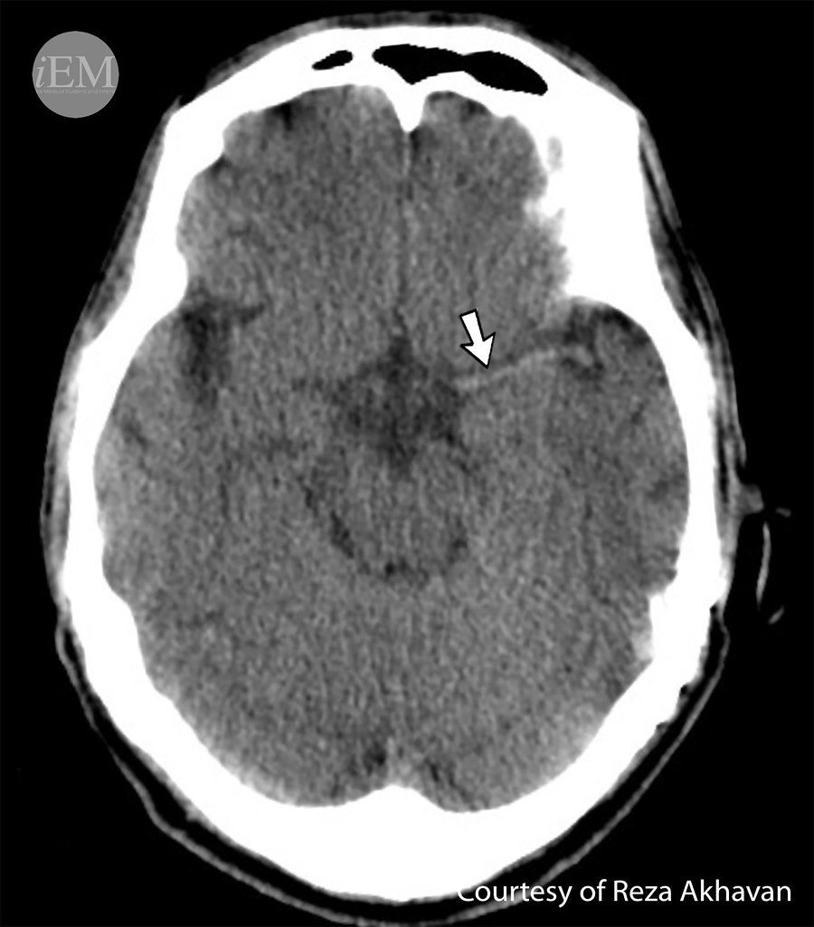 Noncontrast CT brain showing early ischemic stroke sign
