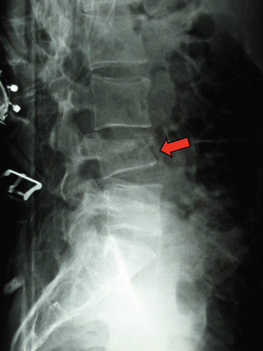 Lateral spine X-ray with arrow marking an L4 compression fracture