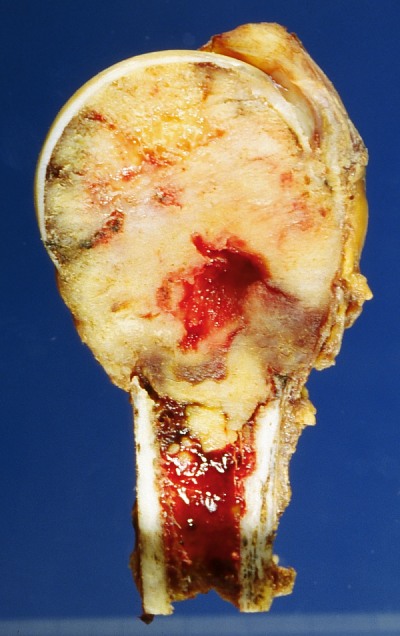 Photograph of a cut humerus showing a large whitish bone metastasis replacing the marrow between the head and the shaft