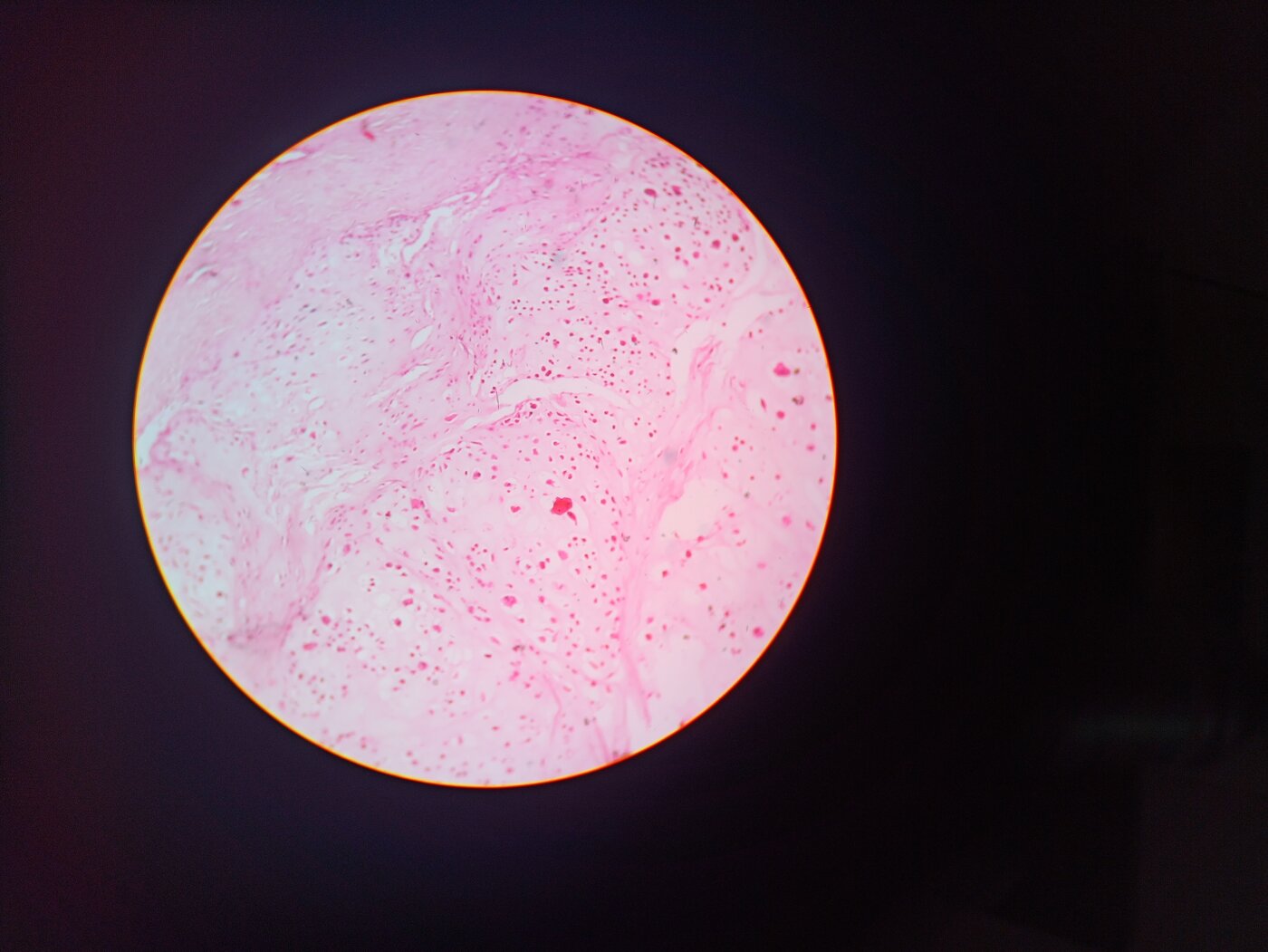 Histology of an enchondroma showing lobules of hyaline cartilage with chondrocytes in lacunae