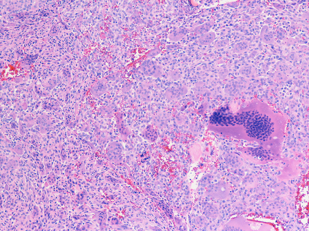 Histology of giant cell tumor of bone showing osteoclast-like giant cells among mononuclear stromal cells