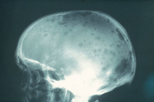 Lateral skull radiograph showing multiple punched-out lytic lesions of multiple myeloma