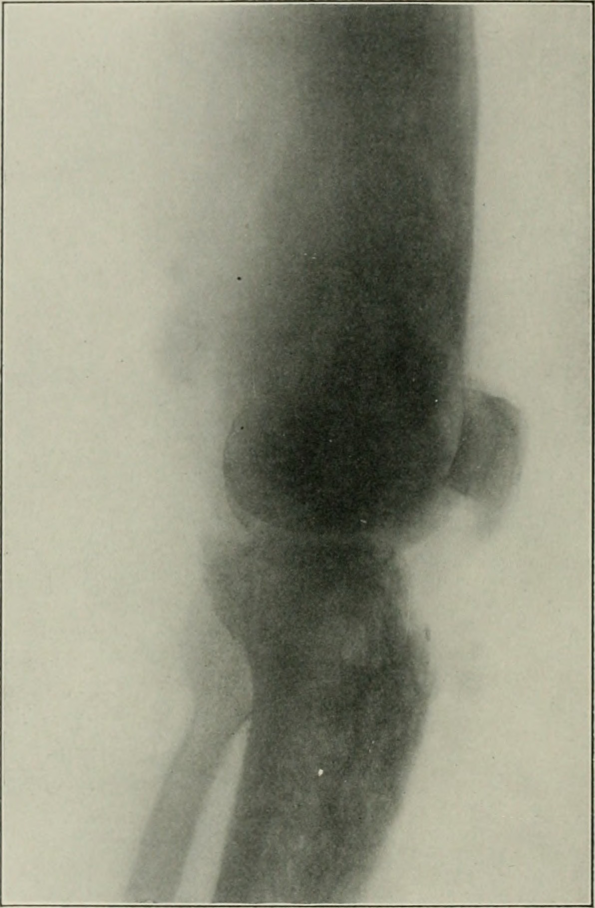 Historical radiograph from 1906 of the distal femur showing an aggressive bone-forming osteosarcoma