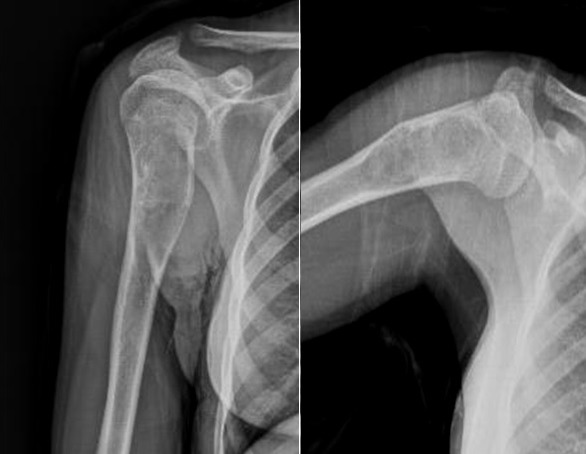 Radiograph of the proximal humerus showing a central lucent unicameral bone cyst with a pathologic fracture
