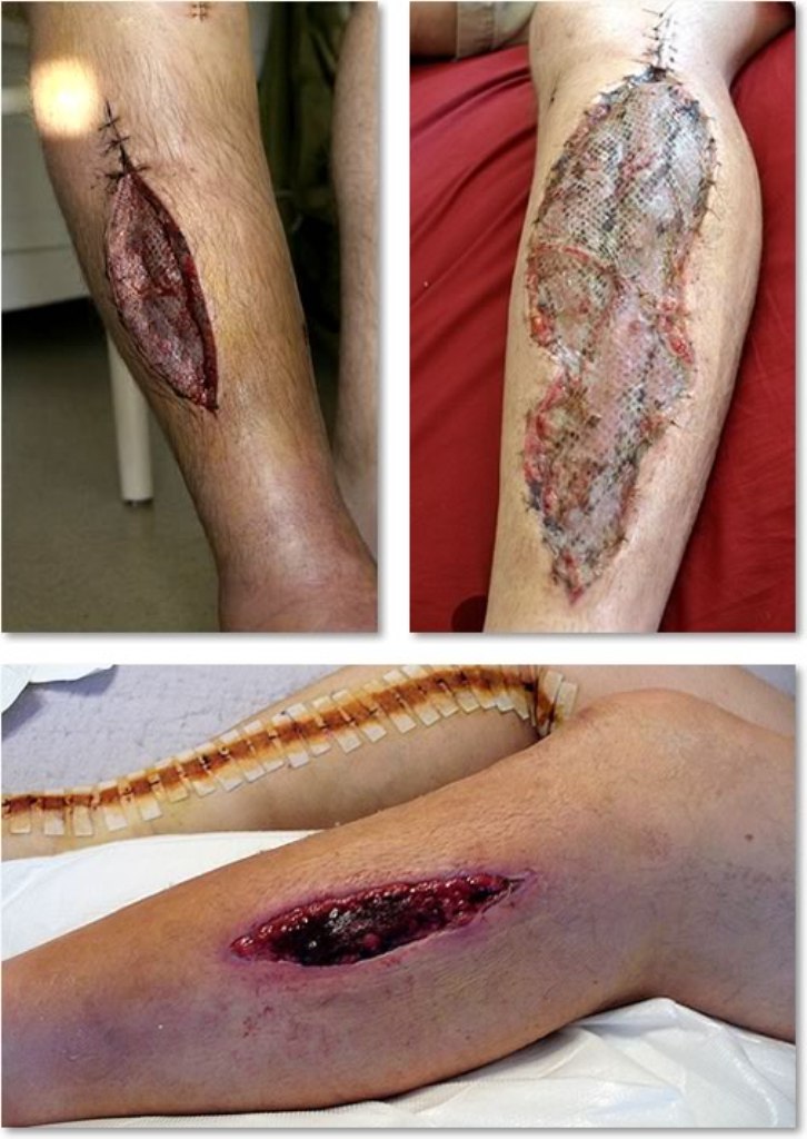 Clinical photograph of a lower leg after fasciotomy for compartment syndrome showing the open fasciotomy wounds and the meshed skin graft used to close them