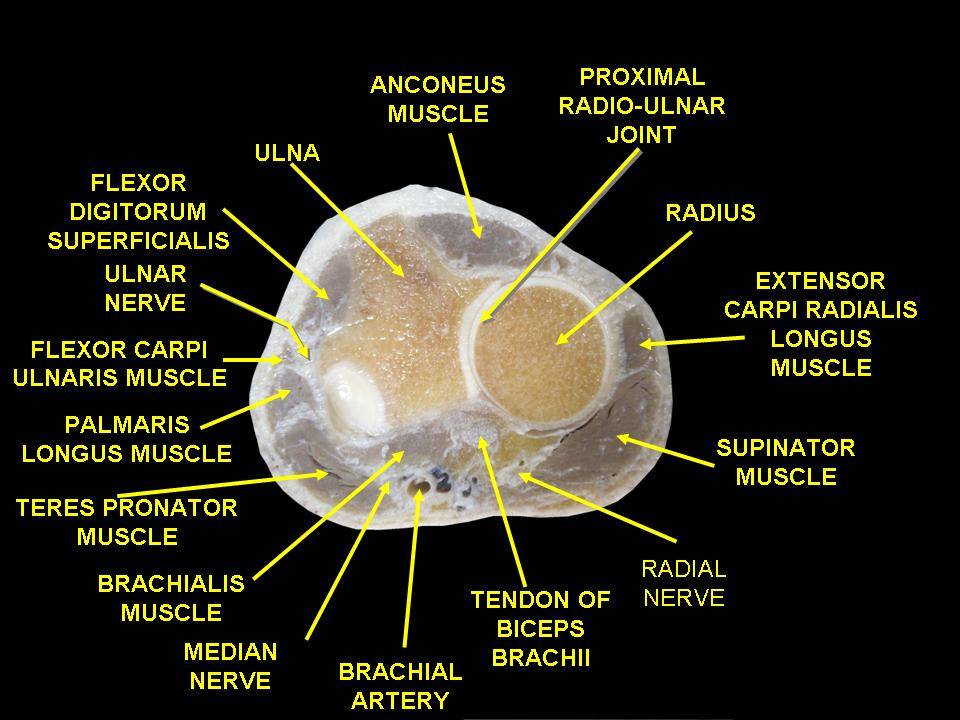 Anatomical cadaver cross section of the proximal forearm showing the radius and ulna, the flexor muscles of the volar compartment with the median and ulnar nerves, and the extensor muscles of the dorsal compartment with the radial nerve