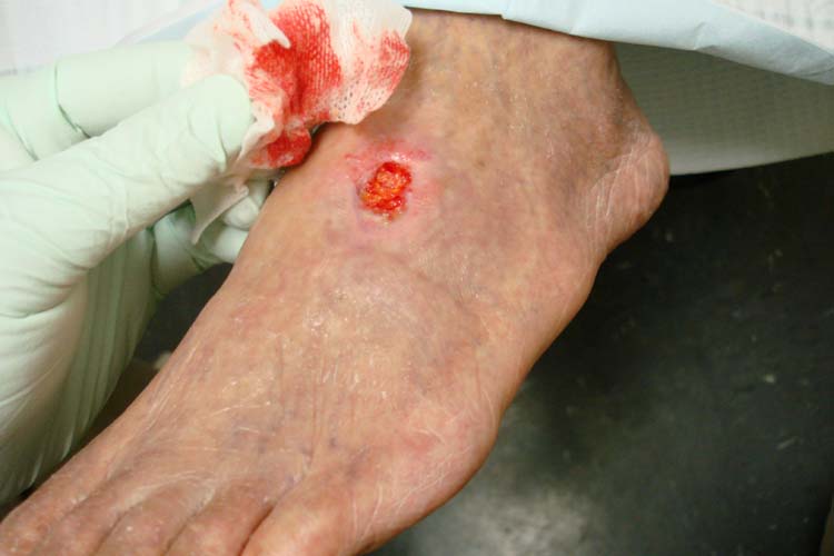 Photograph of an arterial ulcer on the dorsum of the foot with a punched-out wound bed and pale surrounding skin, consistent with ischemic ulceration