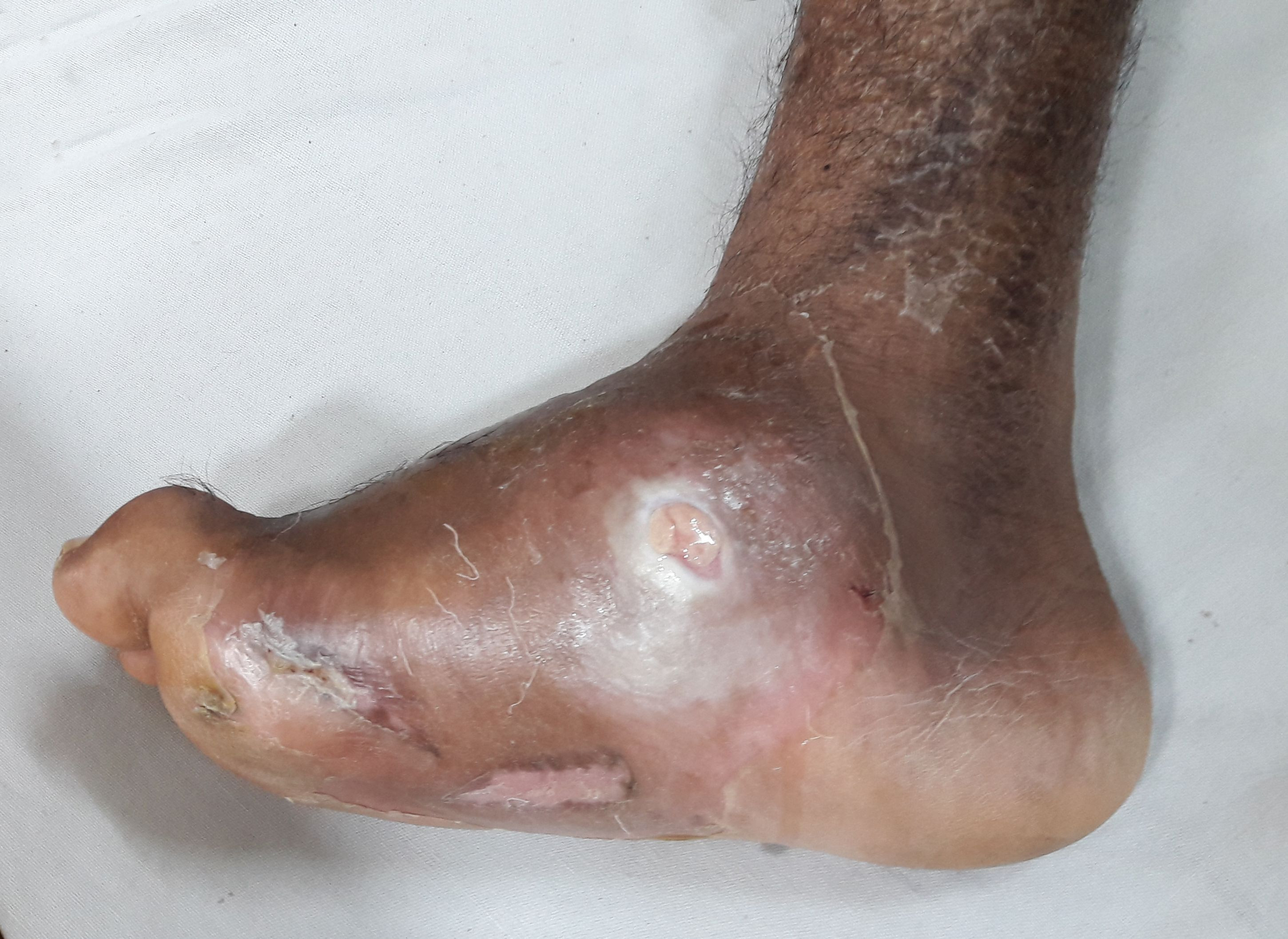 Photograph of a diabetic Charcot foot deformity with midfoot collapse into a rocker-bottom shape and ulceration at the plantar apex