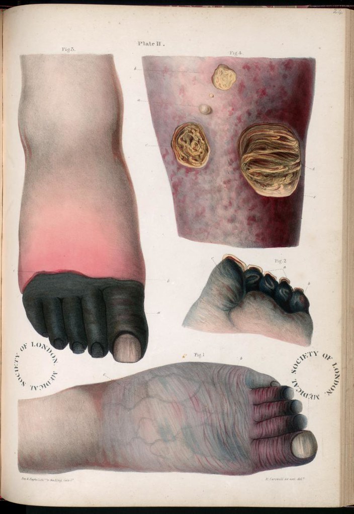 Historical medical plate of dry gangrene of the toes and forefoot with a sharply demarcated necrotic zone, the forefoot gangrene pattern