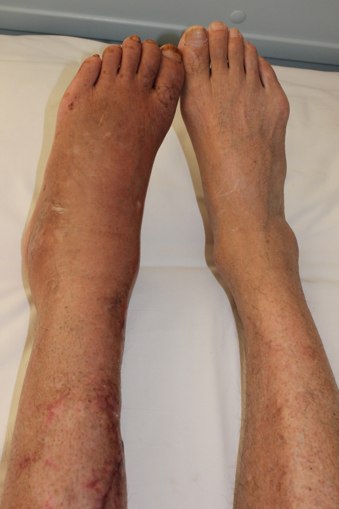 Clinical photograph of complex regional pain syndrome showing swelling, redness, and trophic skin changes of the affected foot and lower leg