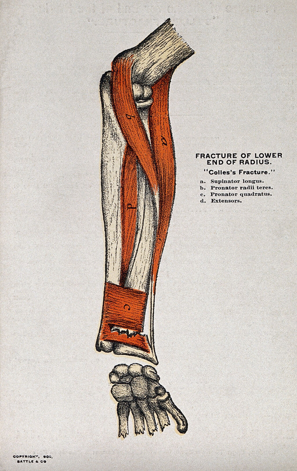 Vintage atlas plate illustrating a Colles fracture of the lower end of the radius with the dinner fork deformity