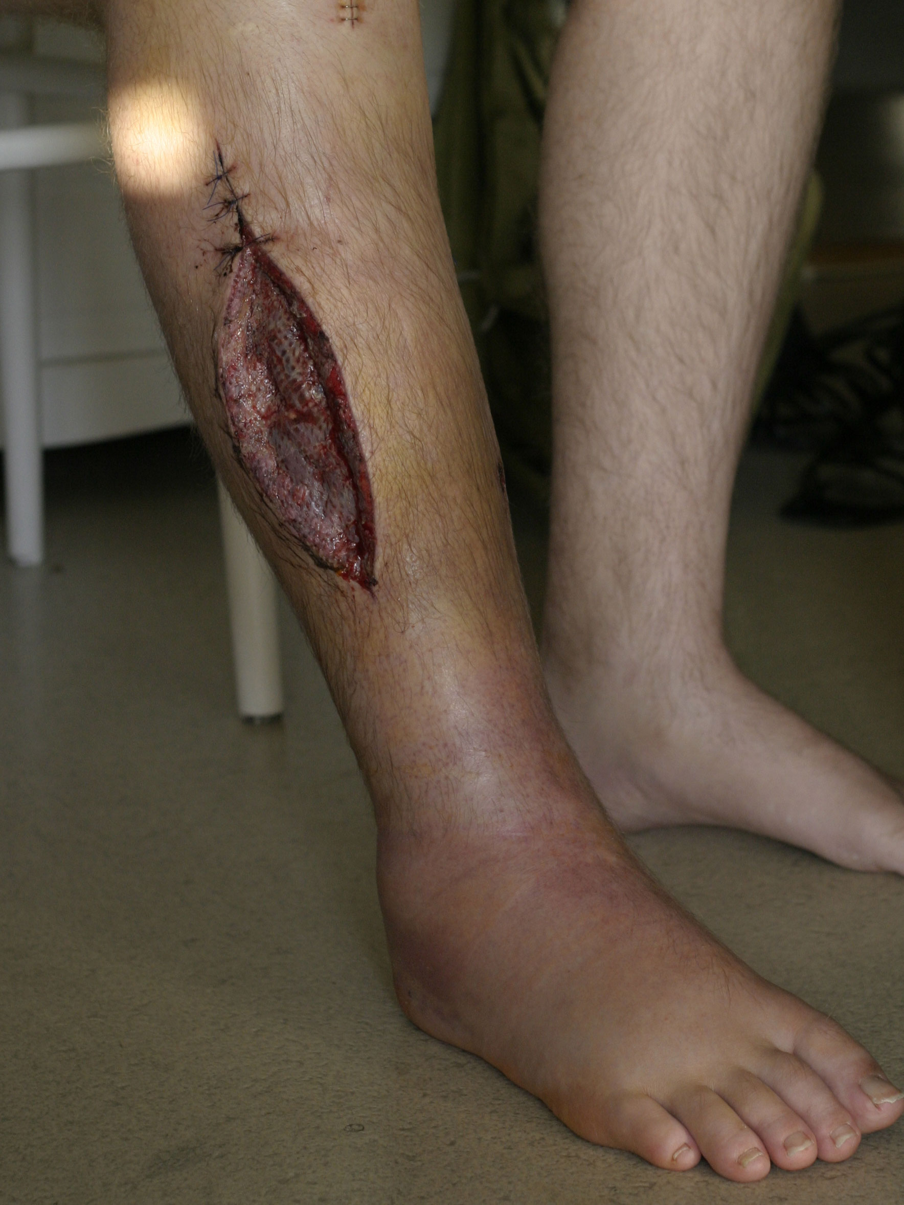 Photograph of a fasciotomy on a tense, swollen leg with compartment syndrome