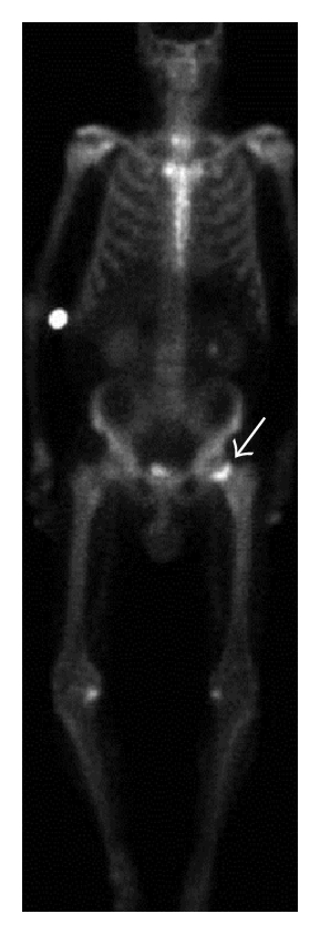 Bone scintigraphy showing increased uptake at a subcapital insufficiency fracture of the femoral neck