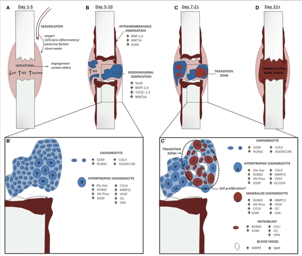 Schematic of fracture healing showing hematoma, soft callus, hard callus, and remodeling