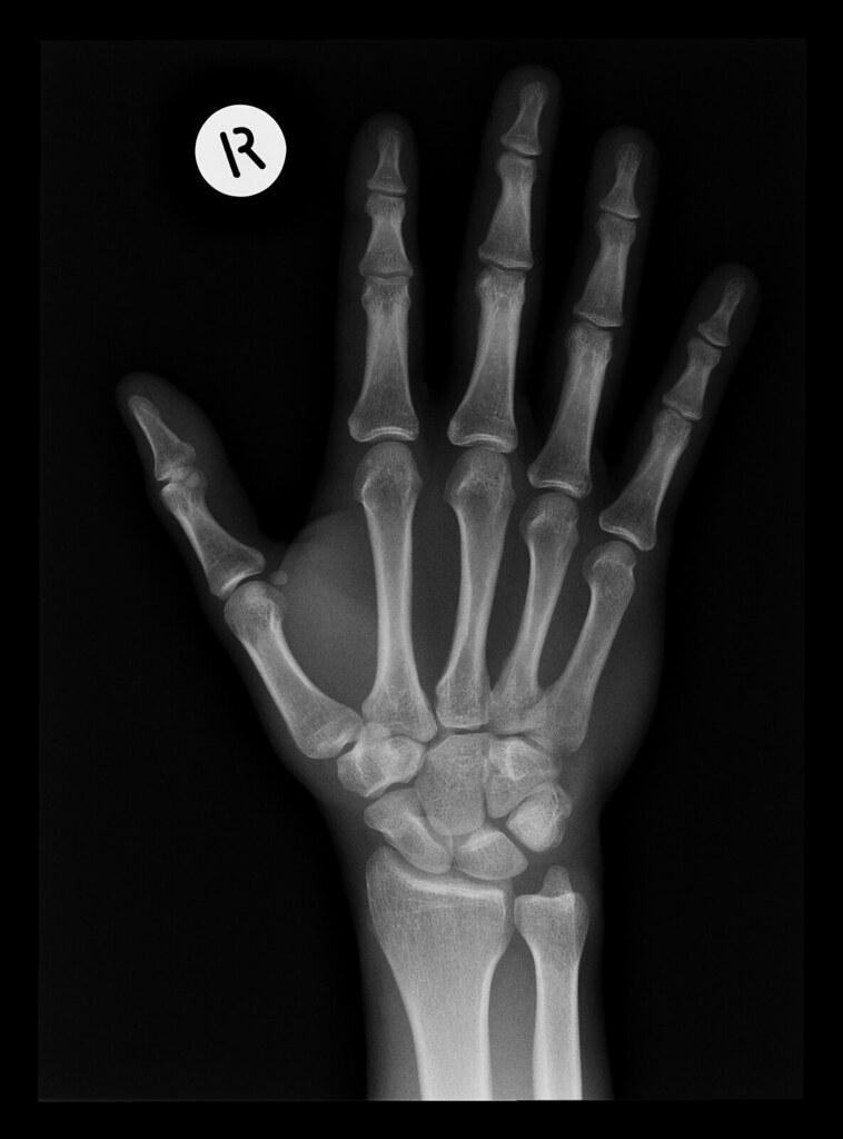 Radiograph of the wrist showing a scaphoid fracture after a fall with snuffbox tenderness