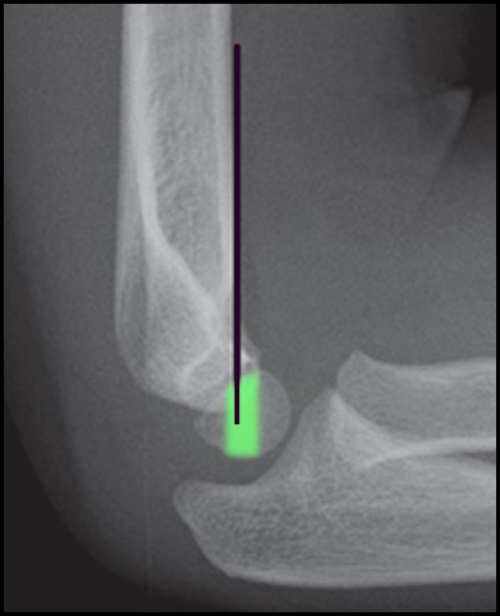 Lateral elbow radiograph in a child with the anterior humeral line drawn for supracondylar fracture assessment