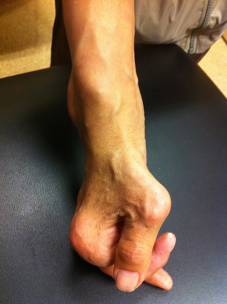 Photograph of a hand with chronic tophaceous gout showing nodular joint deformity and swelling