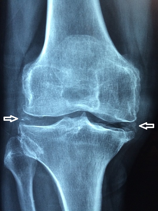Knee radiograph with chondrocalcinosis showing linear meniscal calcification indicated by arrows