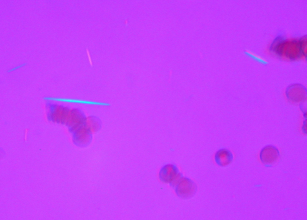 Polarized-light microscopy of joint fluid showing needle-shaped monosodium urate crystals in yellow and blue against a magenta background