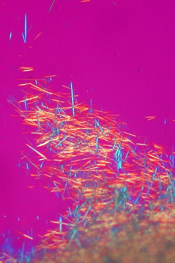 Polarized-light microscopy of dense needle-shaped monosodium urate crystal clusters from tophaceous gout against a magenta background