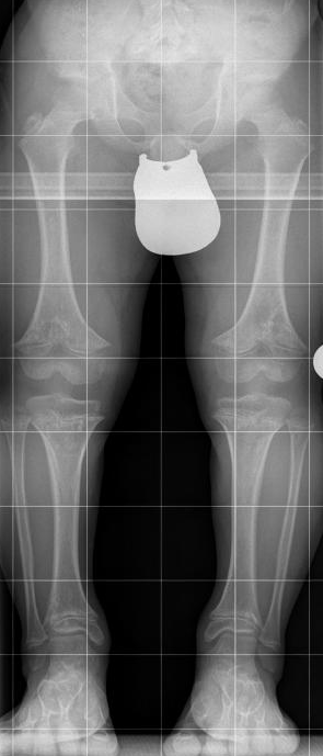 Standing lower limb radiograph in achondroplasia showing the short femurs of endochondral growth failure
