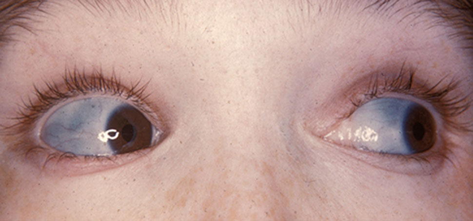 Photograph of blue-gray sclerae in a patient with osteogenesis imperfecta