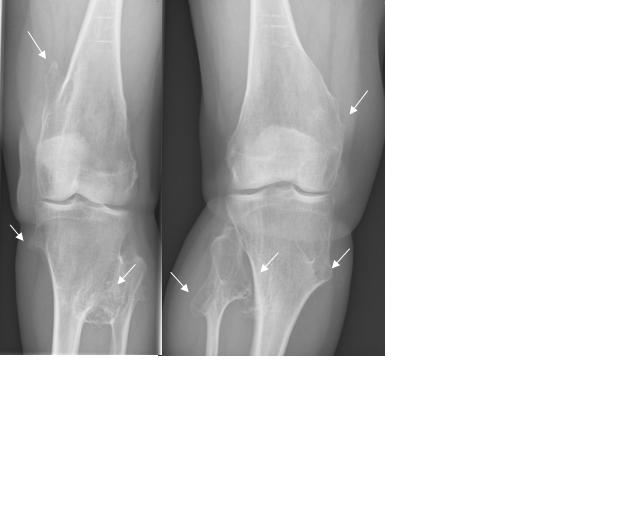 Knee radiograph in a patient with hereditary multiple exostoses showing multiple osteochondromas arising from the metaphyses around the knee