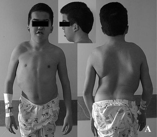 Clinical photograph of a 17-year-old male with osteopetrosis tarda showing cranial deformity and thoracic scoliosis