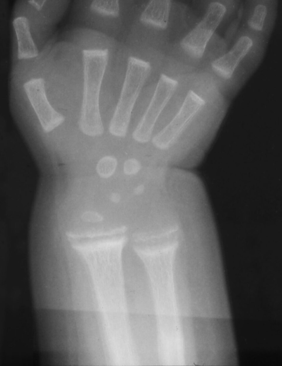 Wrist radiograph in florid rickets showing metaphyseal cupping and fraying