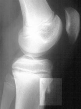 Lateral knee radiograph of an adolescent showing irregular ossification of the tibial tubercle apophysis, the imaging finding of Osgood-Schlatter disease