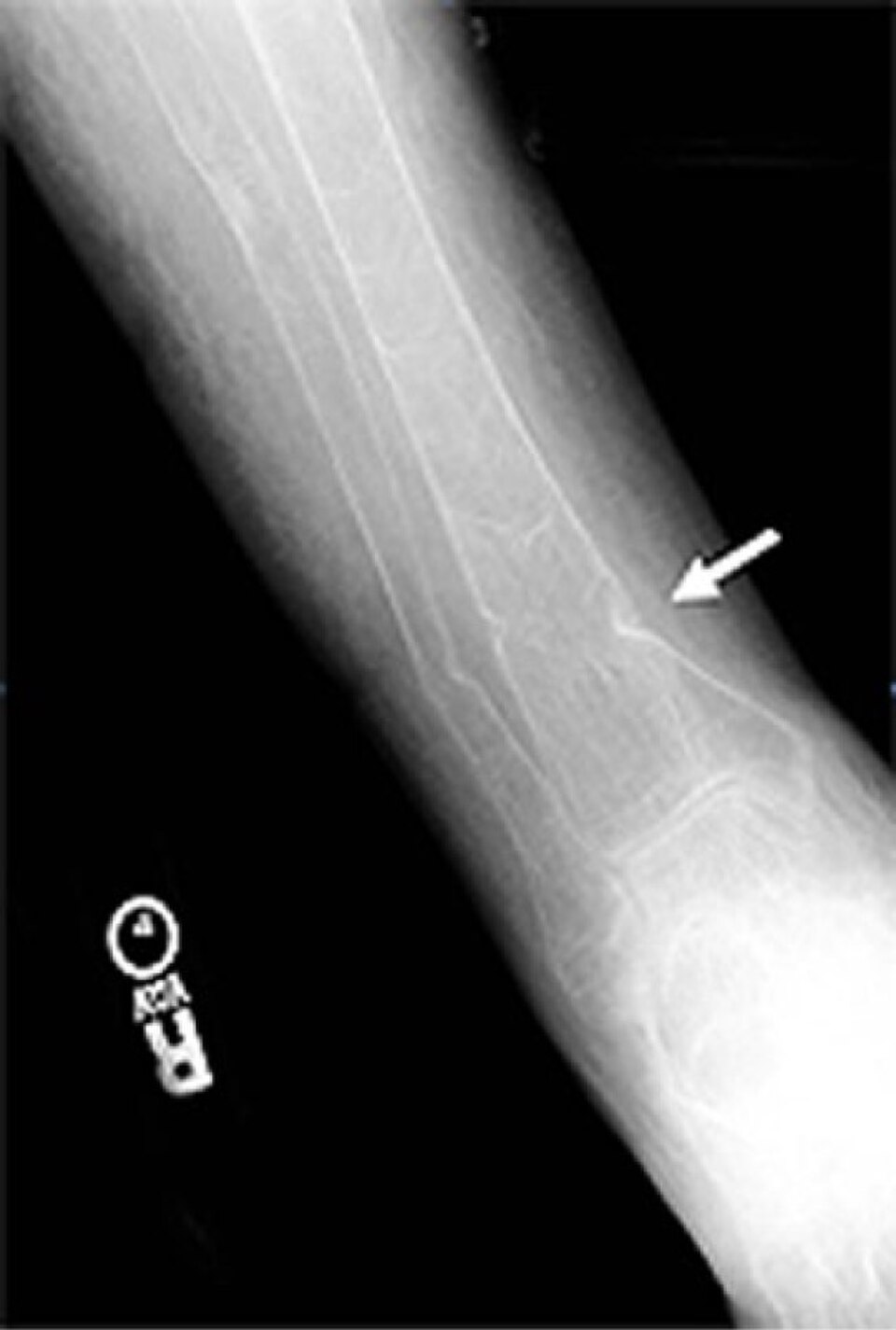 Radiograph of the tibia and fibula showing transverse radiolucent bands, the Looser zones (pseudofractures) of osteomalacia