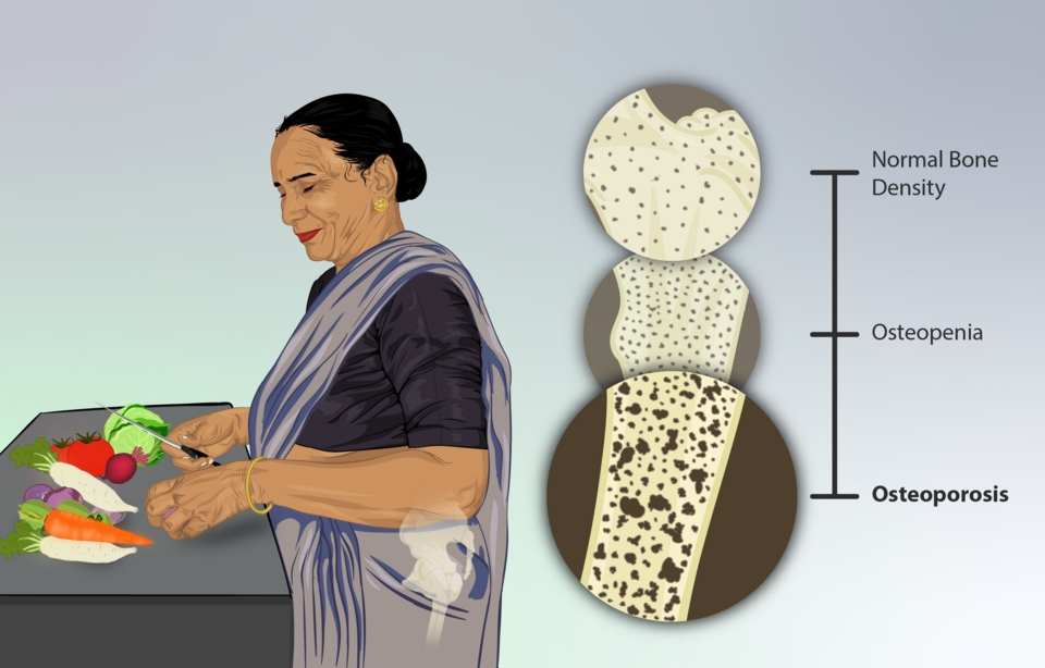 Illustration comparing normal bone, osteopenic bone, and osteoporotic bone showing progressive loss of trabecular mass