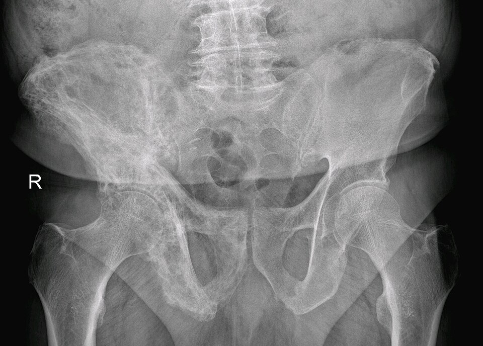 Pelvis radiograph showing cortical thickening of the right ilium in Paget disease