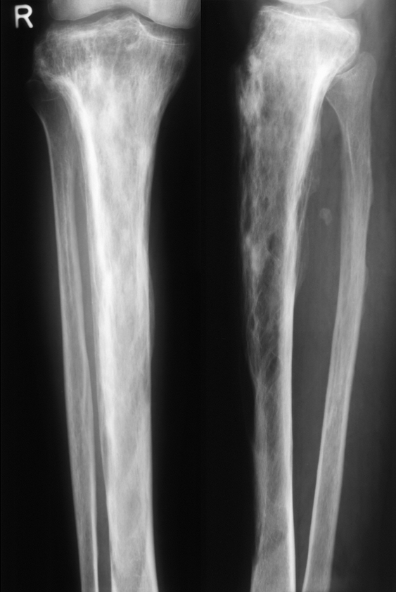 Radiograph of the tibia in Paget disease showing cortical thickening and anterior bowing