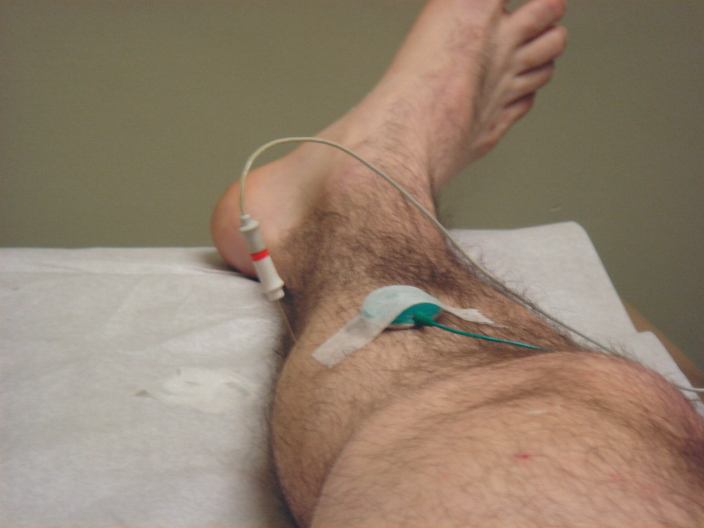 Electromyography needle and nerve conduction study electrodes on a patient calf