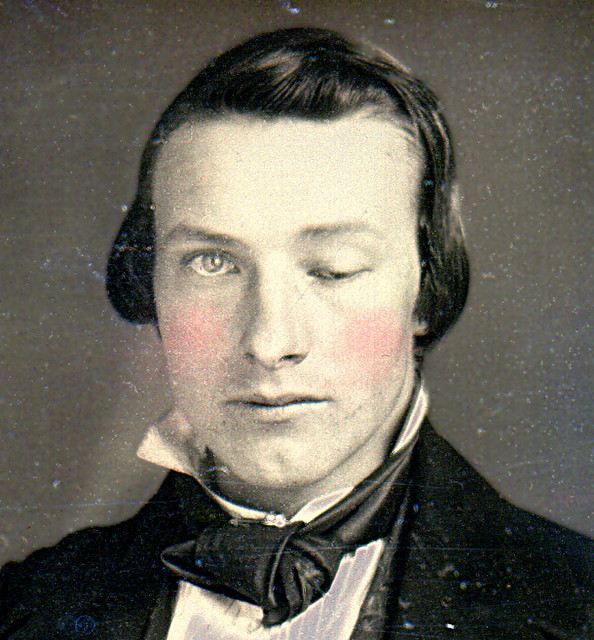 Historical daguerreotype portrait of a patient with drooping of the left upper eyelid (ptosis)
