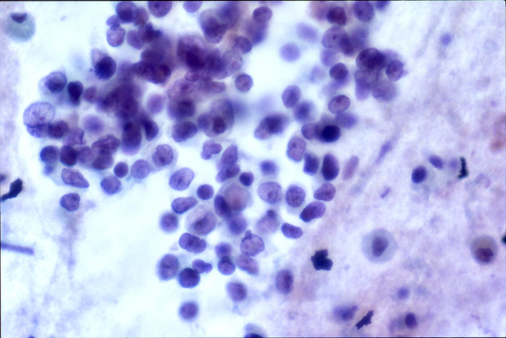 Histology of small cell carcinoma of the lung showing small densely packed cells with scant cytoplasm