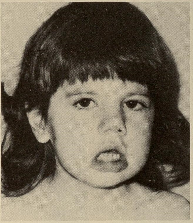 Black and white clinical photograph of a child with myotonic dystrophy showing facial weakness with ptosis and an open mouth posture