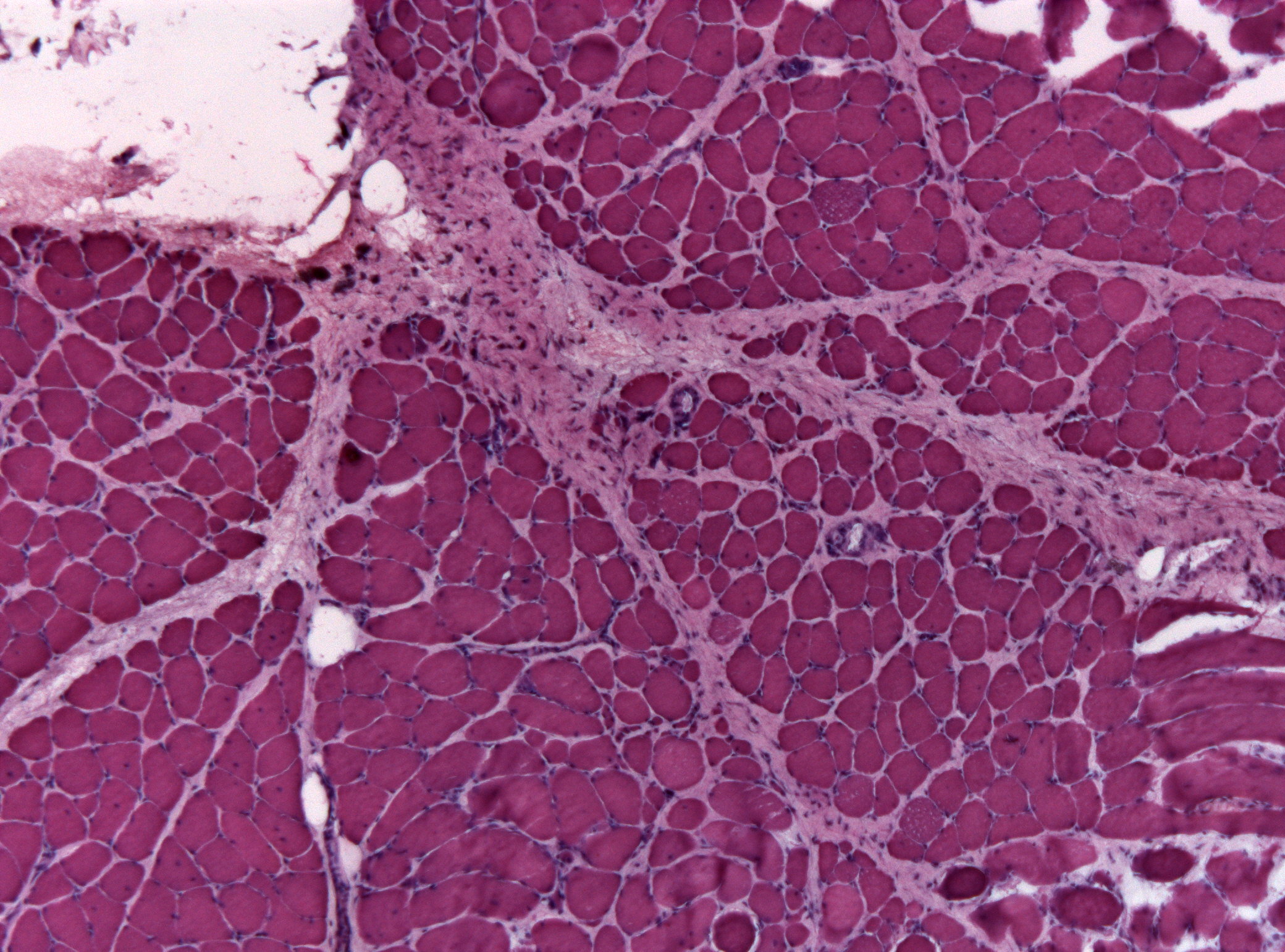 Muscle biopsy H&E histology of dermatomyositis showing perifascicular atrophy with small fibers clustered at the edge of the fascicles