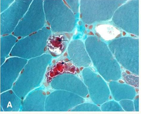 Muscle biopsy histology with modified Gomori trichrome stain showing ragged red fibers in MELAS mitochondrial myopathy
