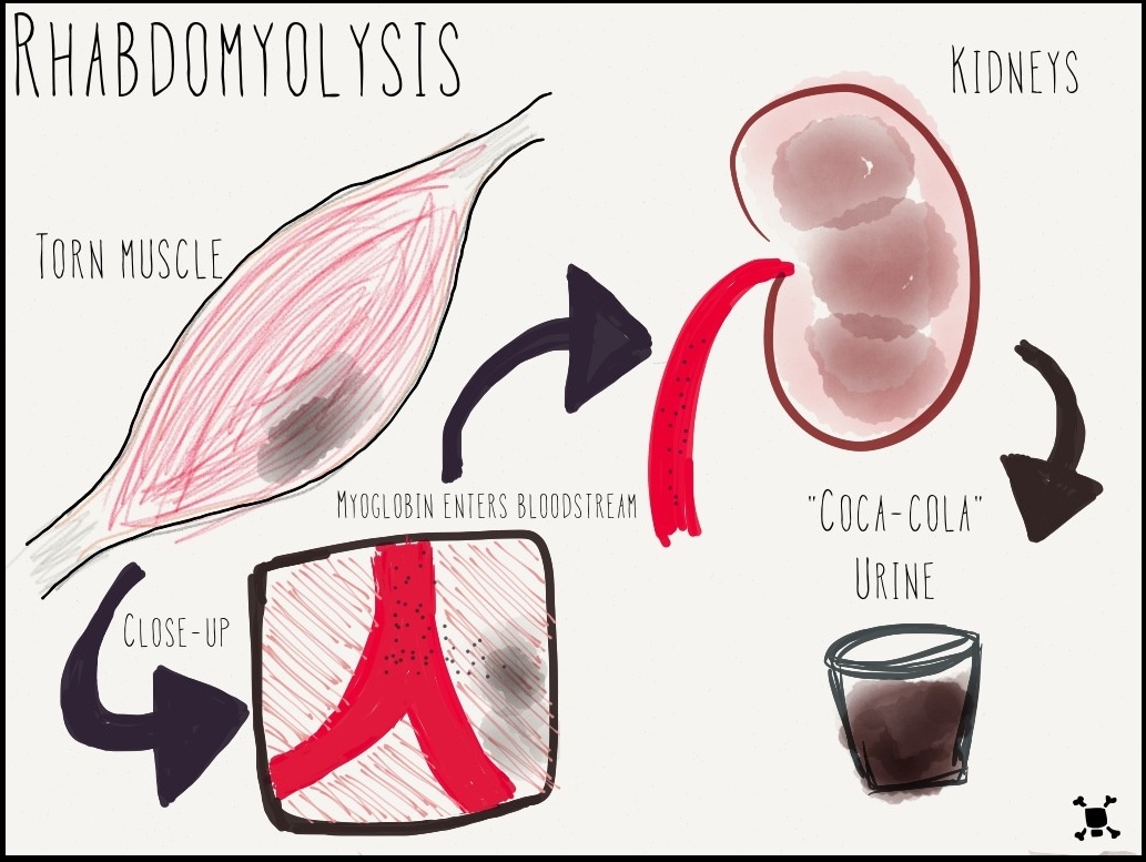 Teaching diagram of rhabdomyolysis showing torn muscle releasing myoglobin into the bloodstream, the kidneys, and dark cola-colored urine