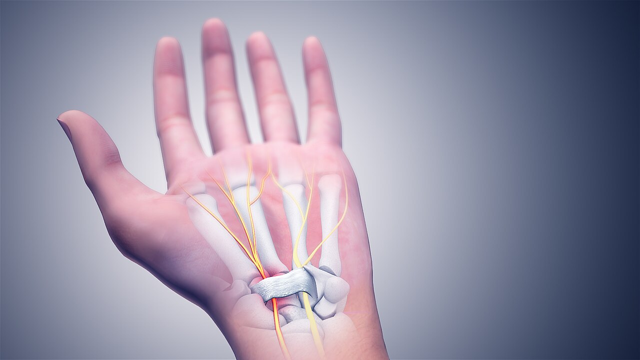 Three-dimensional anatomy rendering of carpal tunnel syndrome showing the median nerve passing beneath the transverse carpal ligament of the wrist