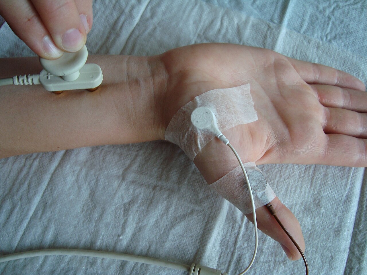 Clinical photograph of a nerve conduction study with a stimulating electrode on the wrist and recording electrodes over the thenar muscles, the median nerve motor study