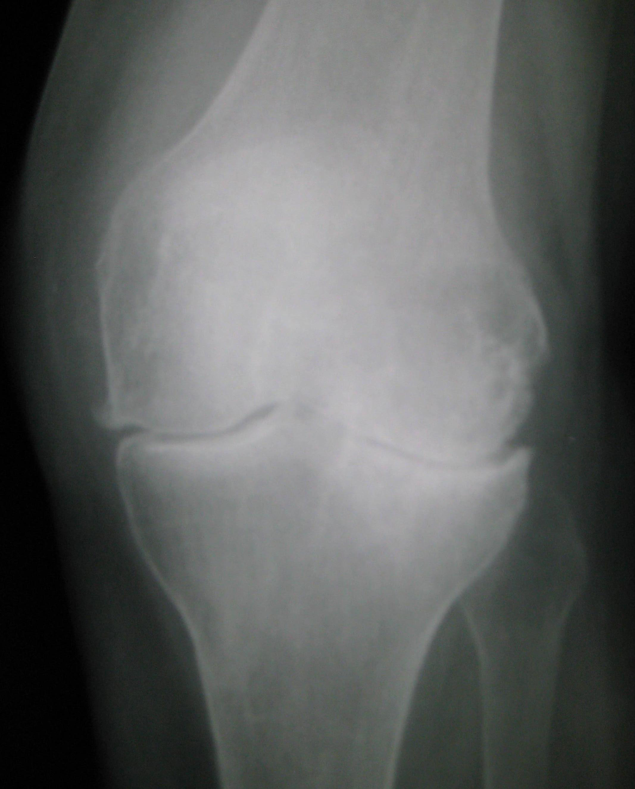 Radiograph of a knee with osteoarthritis showing medial joint space narrowing, marginal osteophytes, and subchondral sclerosis