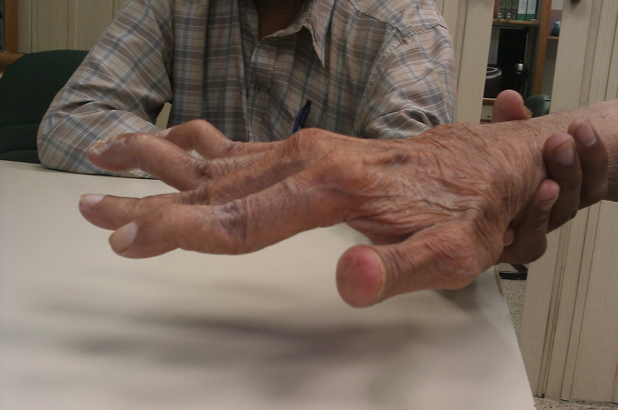 Photograph of a rheumatoid arthritis patient's hand showing swan-neck deformity of the index finger with PIP hyperextension and DIP flexion