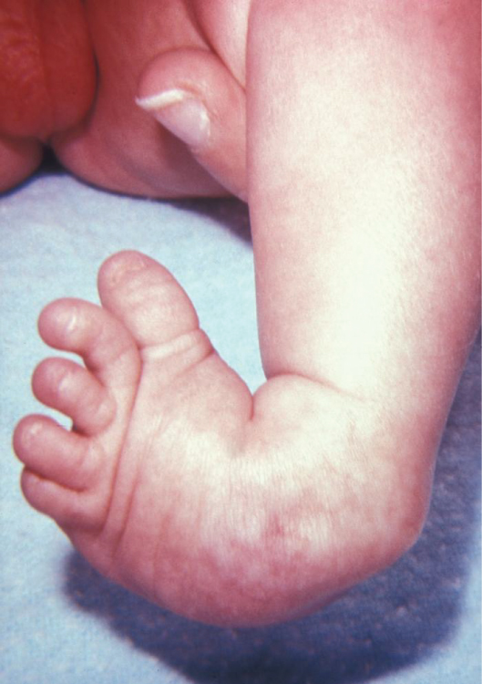 Photograph of an infant with clubfoot (talipes equinovarus) showing the right foot turned inward and pointing downward with a high medial arch