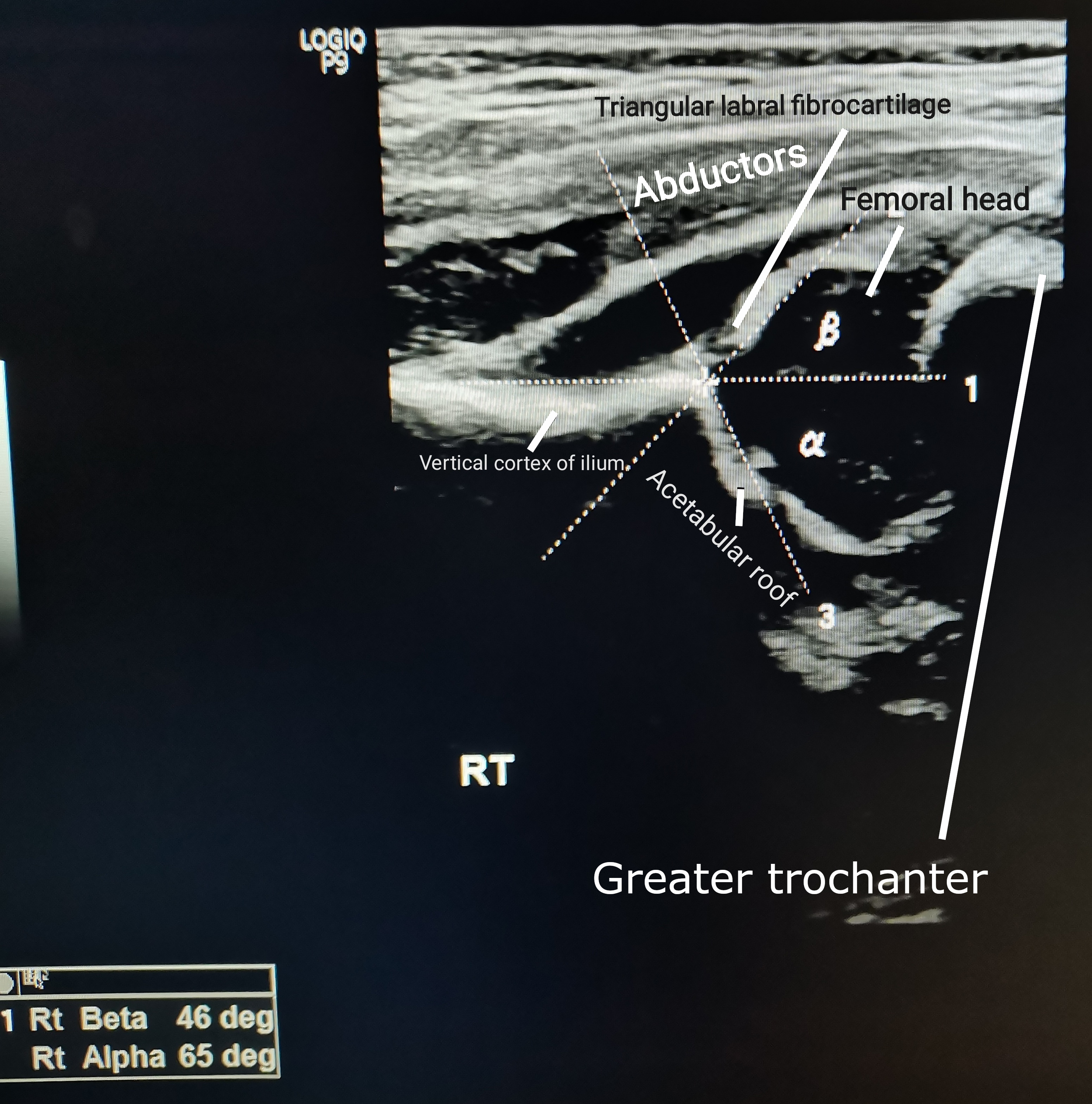 Hip ultrasound (Graf method) of the right hip showing the femoral head seated in the acetabulum with the alpha and beta angles measured on the bony and cartilaginous roof