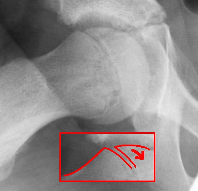 Frog-leg lateral hip radiograph of a slipped capital femoral epiphysis with red annotation tracing the step-off at the inferior femoral head-neck junction